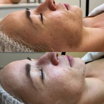 Veido odos pokytis prieš ir po 3 PRX-T33 procedūrų — Skinformula, Vilnius