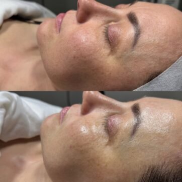 Veido odos pokytis prieš ir po procedūros su THESERA egzosomomis — Skinformula, Vilnius