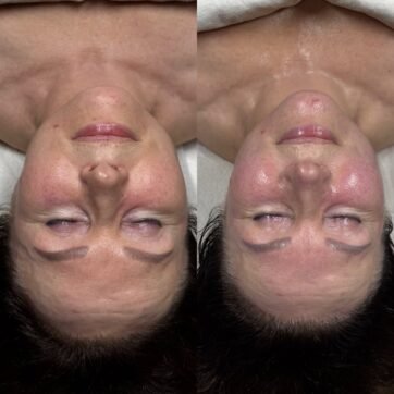 Veido odos pokytis prieš ir po atlikto Kobido veido masažo — Skinformula, Vilnius
